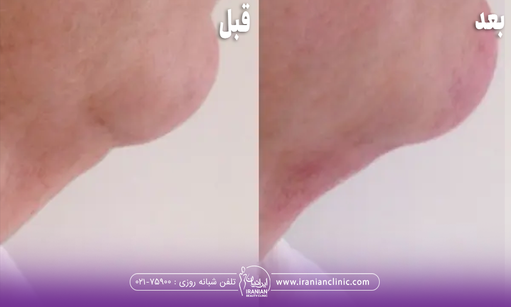 عکس قبل و بعد فردی که اندولیفت غبغب انجام داده است