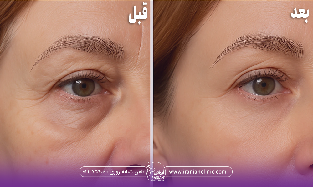 قبل و بعد فردی که اندولیفت انجام داده است