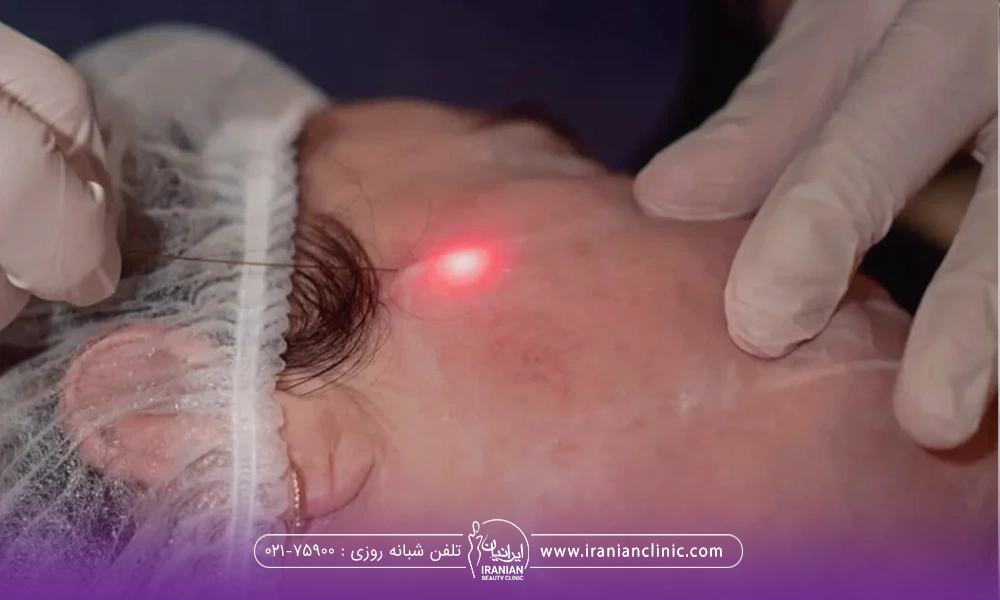 دستان پزشکی که میکروفیبر اندولیفت را زیر پوست گونه فرد فرو می برد