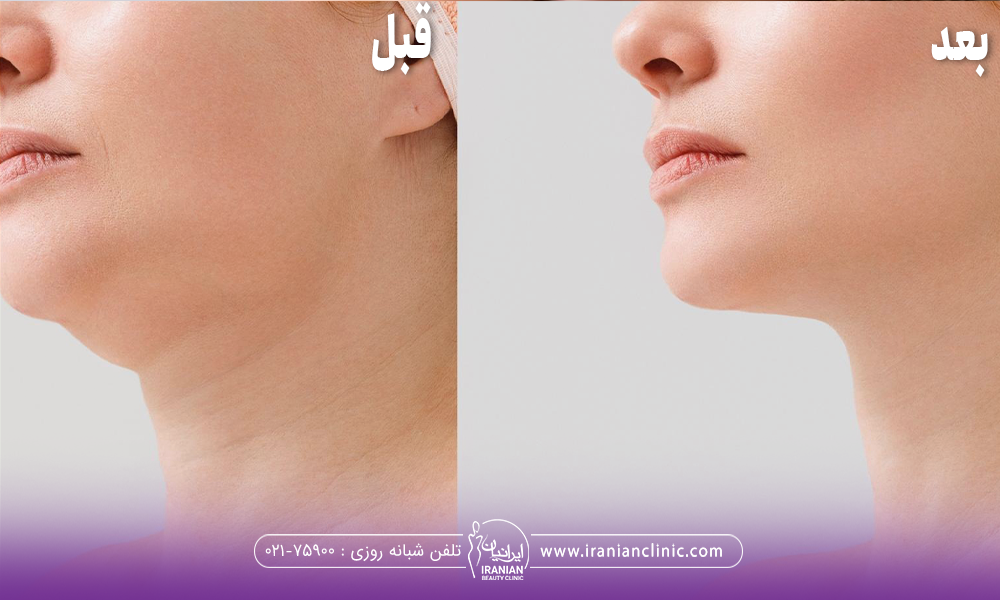 عکس قبل و بعد فردی که اندولیفت غبغب انجام داده است