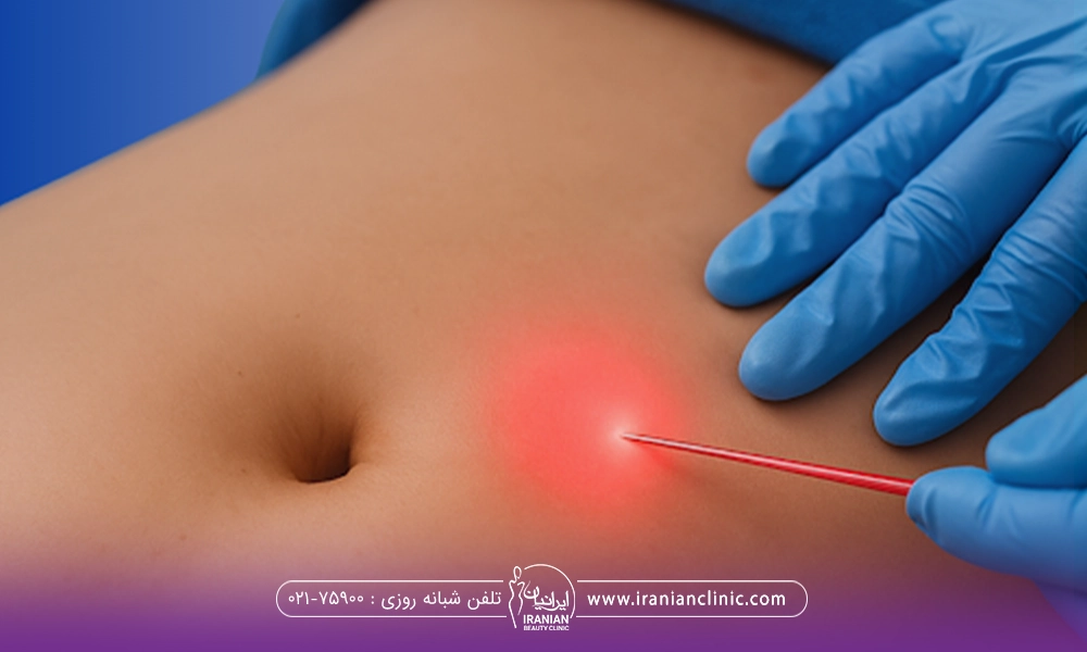 پزشک با دستکش های آبی که ناحیه شکم فرد را اندولیفت انجام داده است