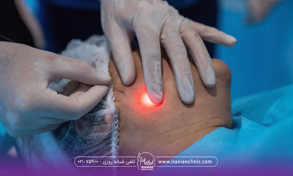 فردی که صورت خود را برگردانده و پزشک میکروفیبر را زیر پوست او در ناحیه فک فرو برده است