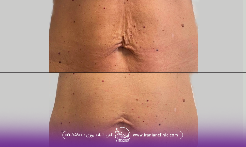 قبل و بعد فردی برای شکمش را اندولیفت انجام داده است
