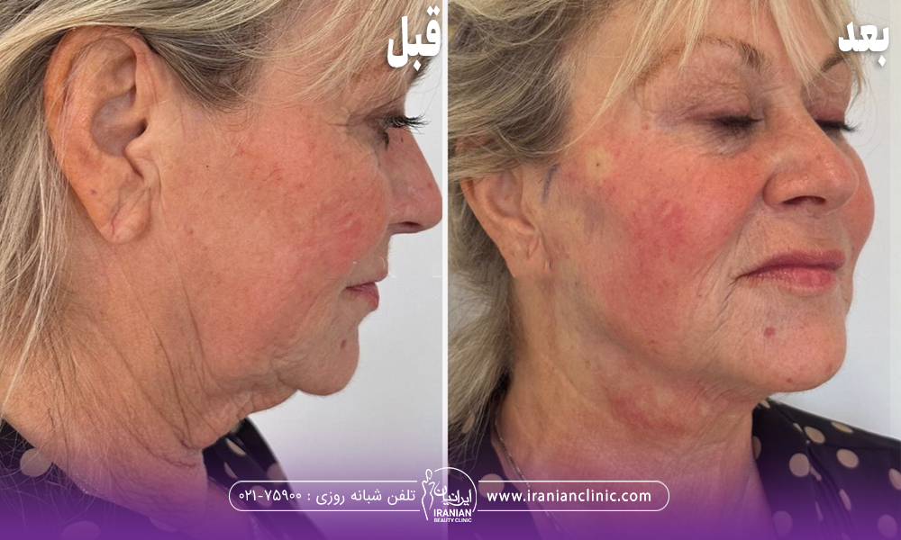 عکس قبل و بعد از اندولیفت گونه خانم میانسال که باعث شده است صورت او پرتر شود و همچنین پوست او قرمز و ملتهب شده است