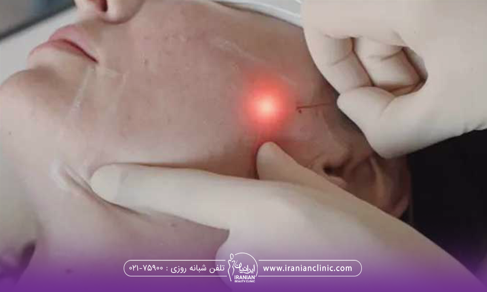 صورت فردی که میکروفیبر اندولیفت زیر آن قرار گرفته است و نور قرمز از زیر پوست مشخص است