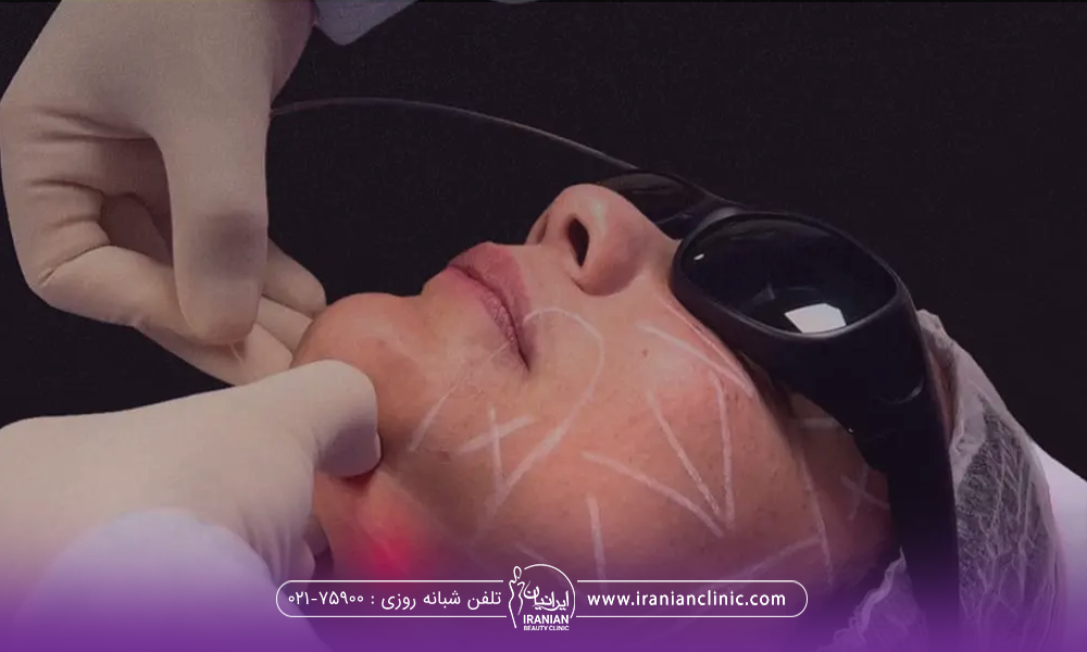 فردی که کلاه و عینک مخصوص زده و دستان دکتری که در حال انجام اندولیفت غبغب فرد است