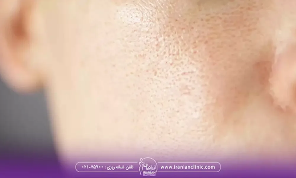 علت بزرگ شدن منافذ پوست صورت چیست؟