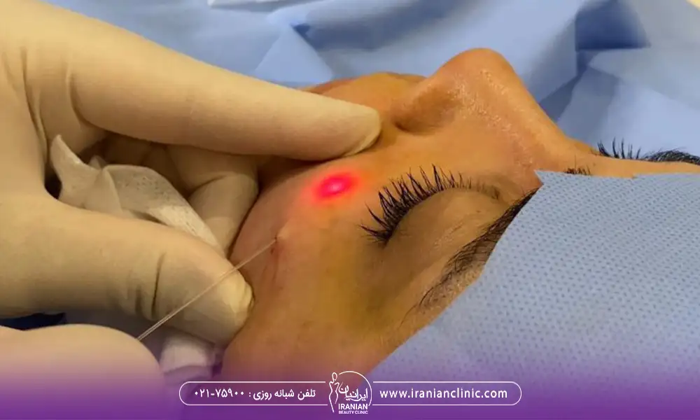 انواع اندولیفت