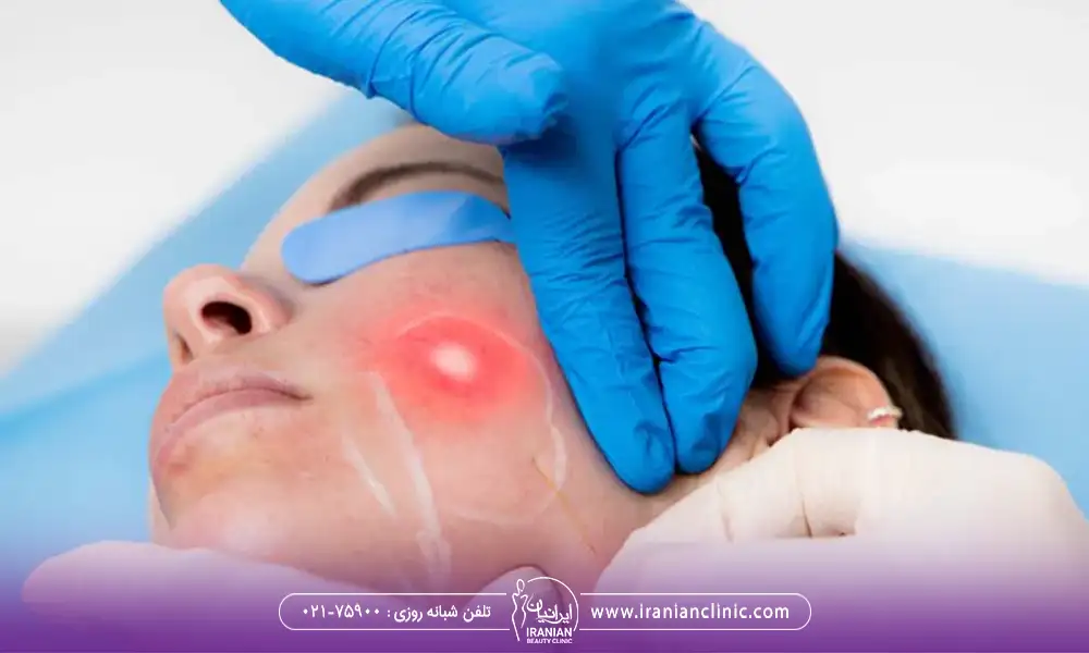 اندولیفت گونه برای چه کسانی مناسب