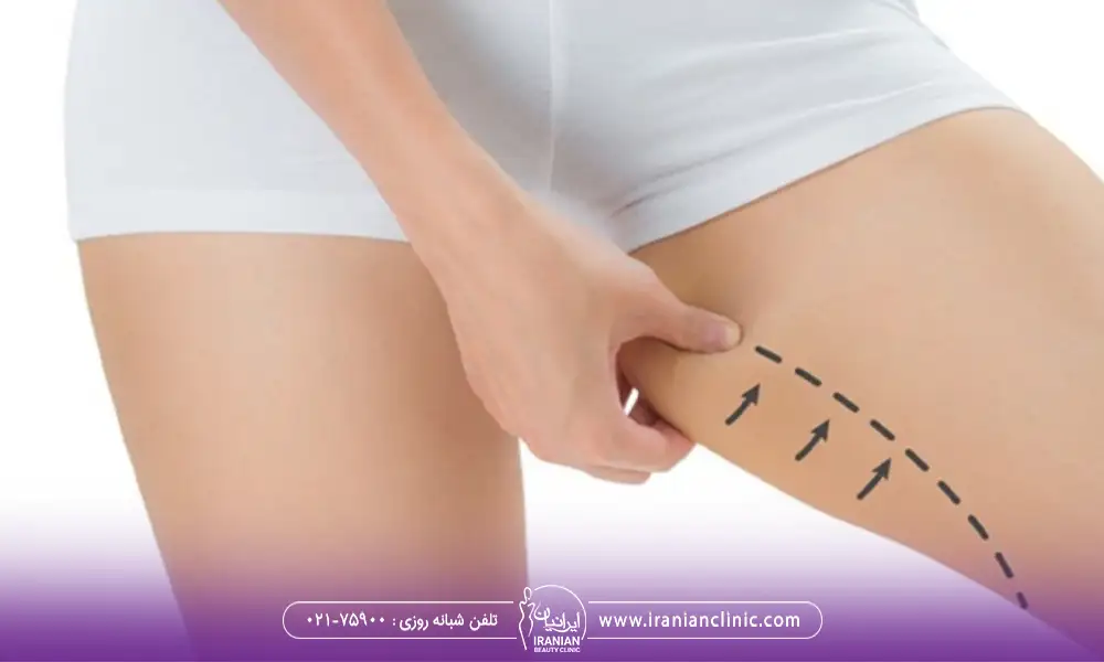 اندولیفت برای کشاله ران و مشخص کردن ناحیه ای که قرار است اندولیفت شود.
