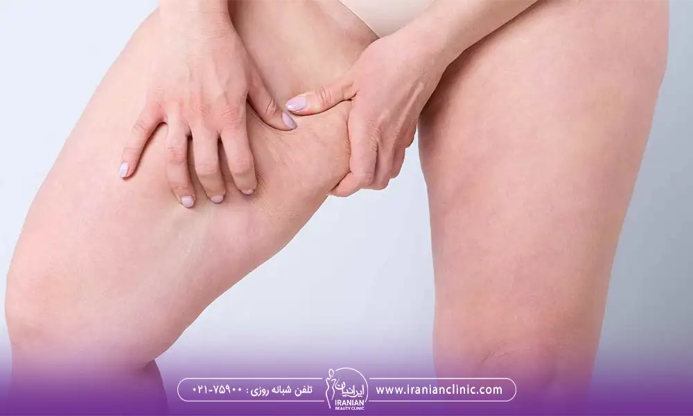 اندولیفت برای کشاله ران