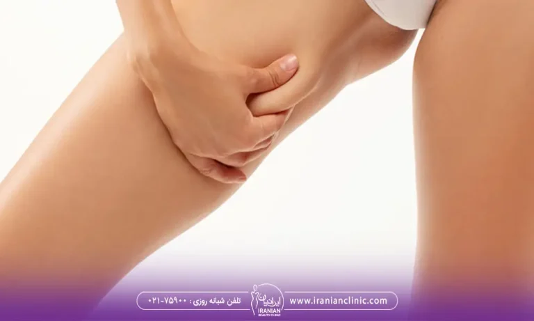 اندولیفت برای کشاله ران رو جوانسازی و لاغری کشاله