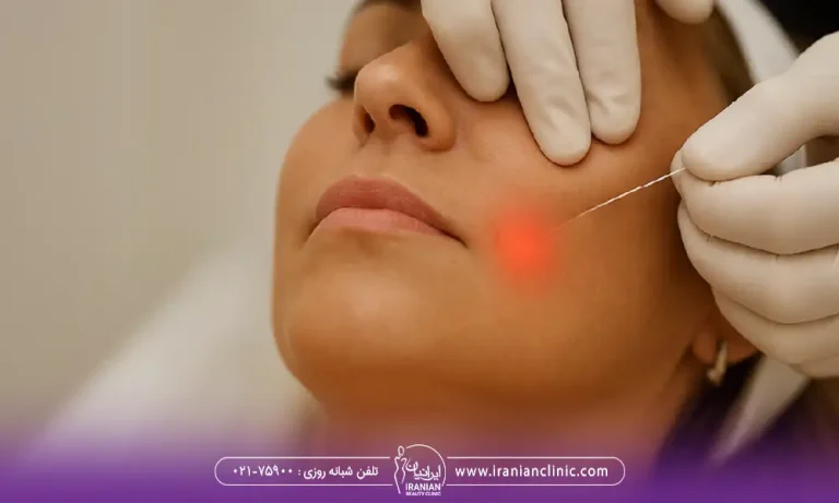 اندولیفت خط خنده در درد اندولیفت