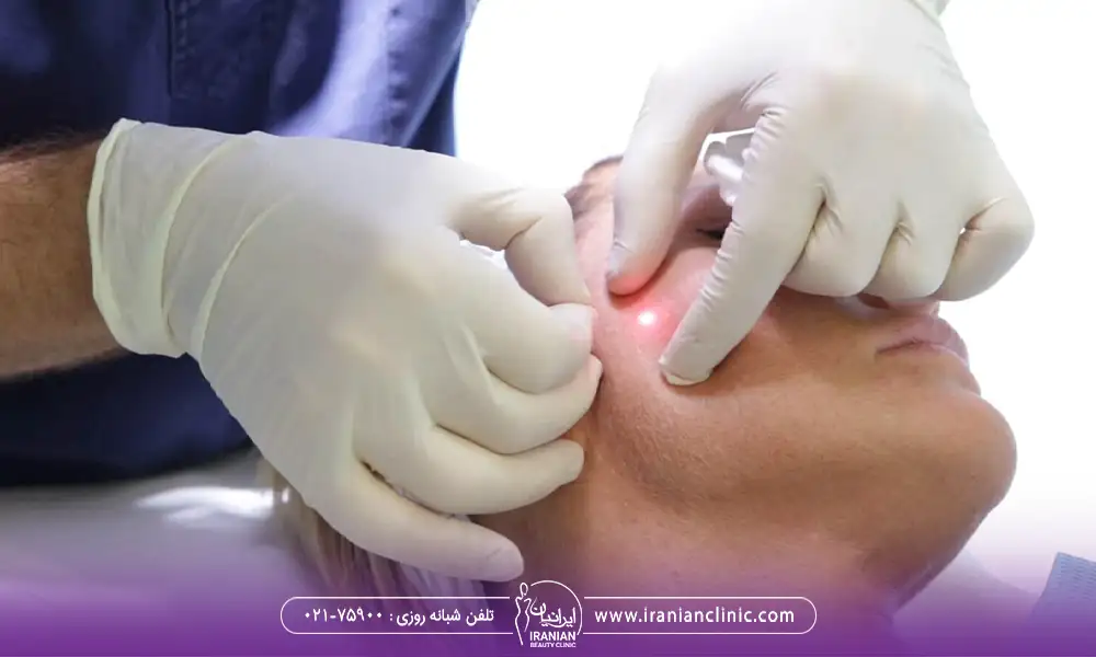 انواع اندولیفت برای گونه