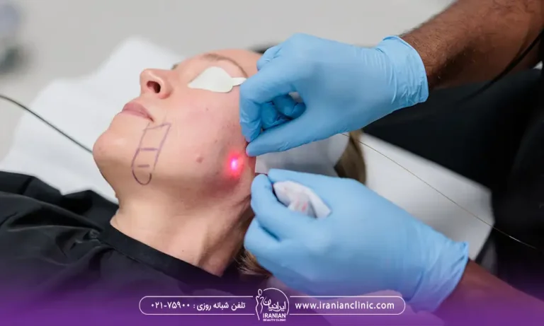 اندولیفت برای چه کسانی مناسب است افتادگی پوست دارند.