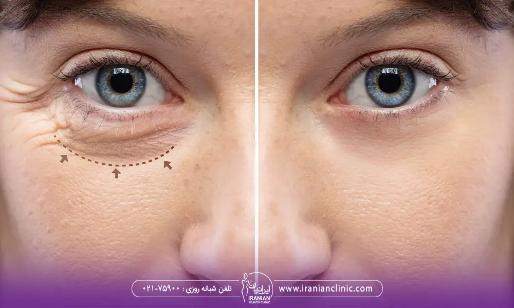 عکس قبل و بعد اندولیفت رفع خطوط ریز دور چشم
