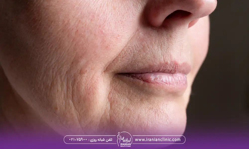 نتایج رفع افتادگی پوست پوست بدون جراحی