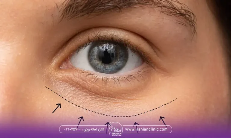 عکس رفع خطوط ریز دور چشم با اندولیفت
