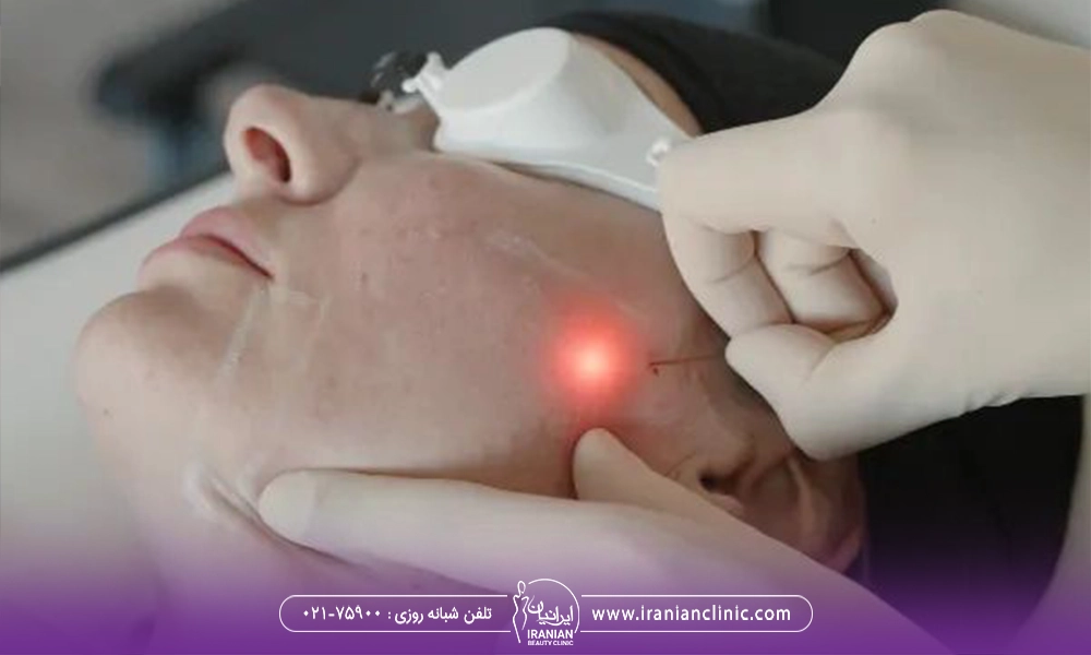 مزایای اندولیفت گونه