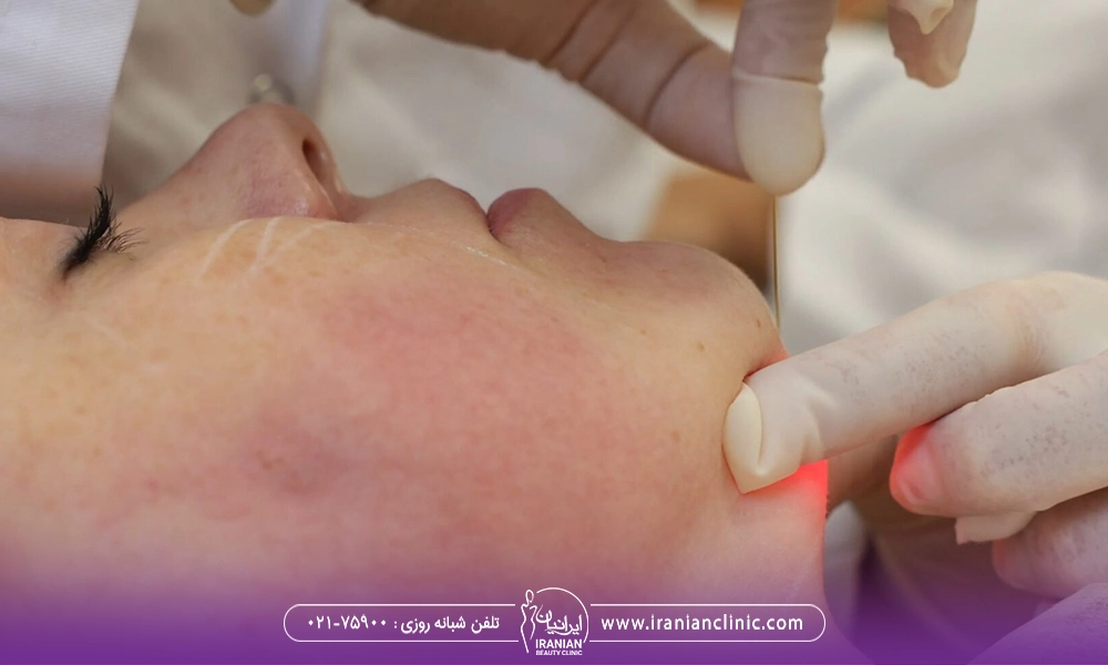 تصویر اندولیفت غبغب | ورم بعد از اندولیفت