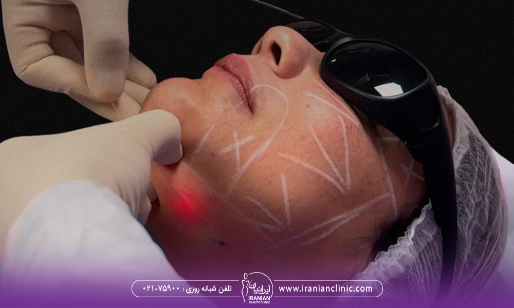 عملکرد دستگاه اندولیفت روی غبغب