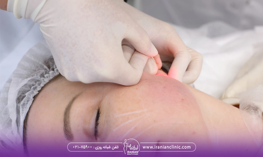 اندولیفت زاویه فک و بی حسی بعد از اندولیفت