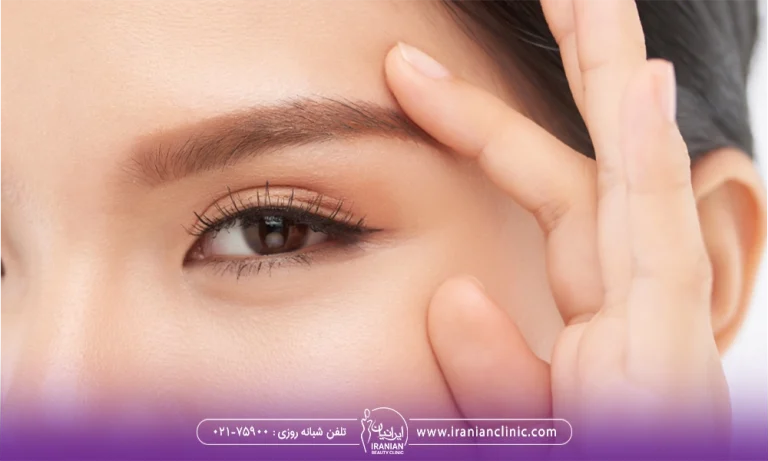 نتیجه ابرویی زیبا بعد از لیفت ابرو بدون جراحی