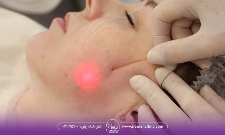 بی حسی بعد از اندولیفت گونه