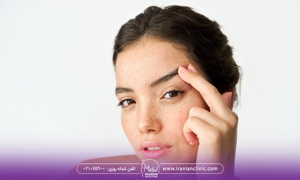 لیفت ابرو بدون جراحی