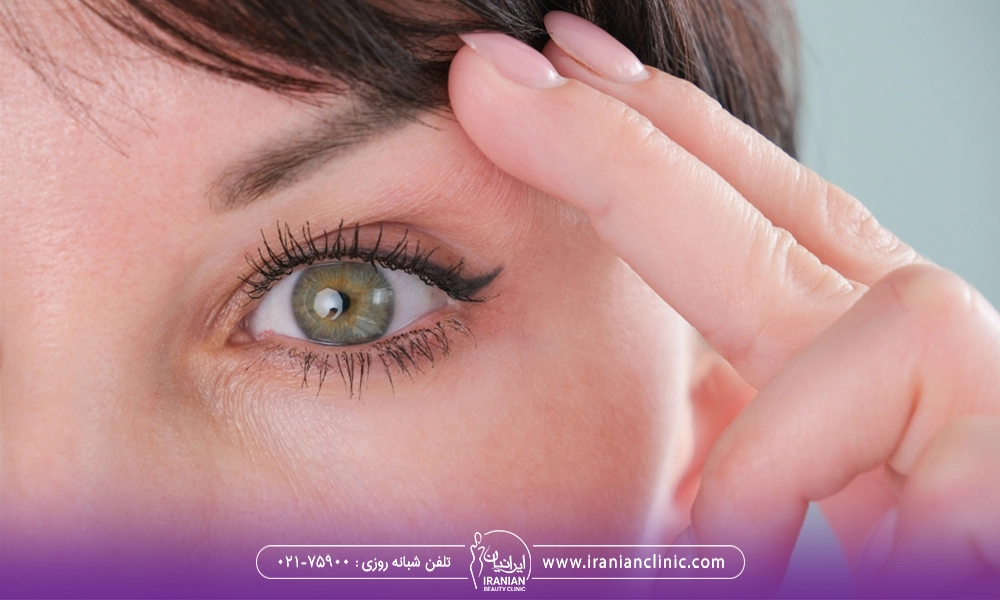 ابرو های لیفت شده بعد از لیفت ابرو بدون جراحی