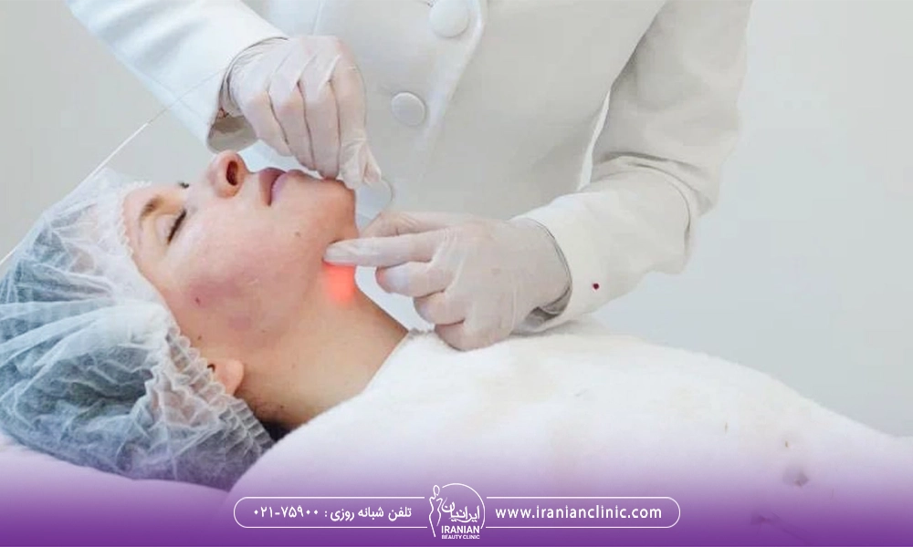 ورم بعد از اندولیفت