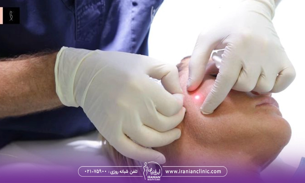 مزایای اندولیفت چانه