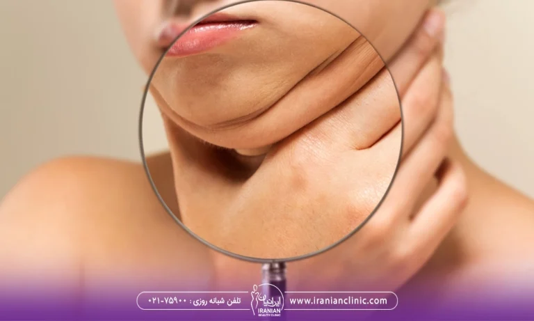 غبغب خانمی که که دنبال سریعترین روش از بین بردن غبغب می باشد.